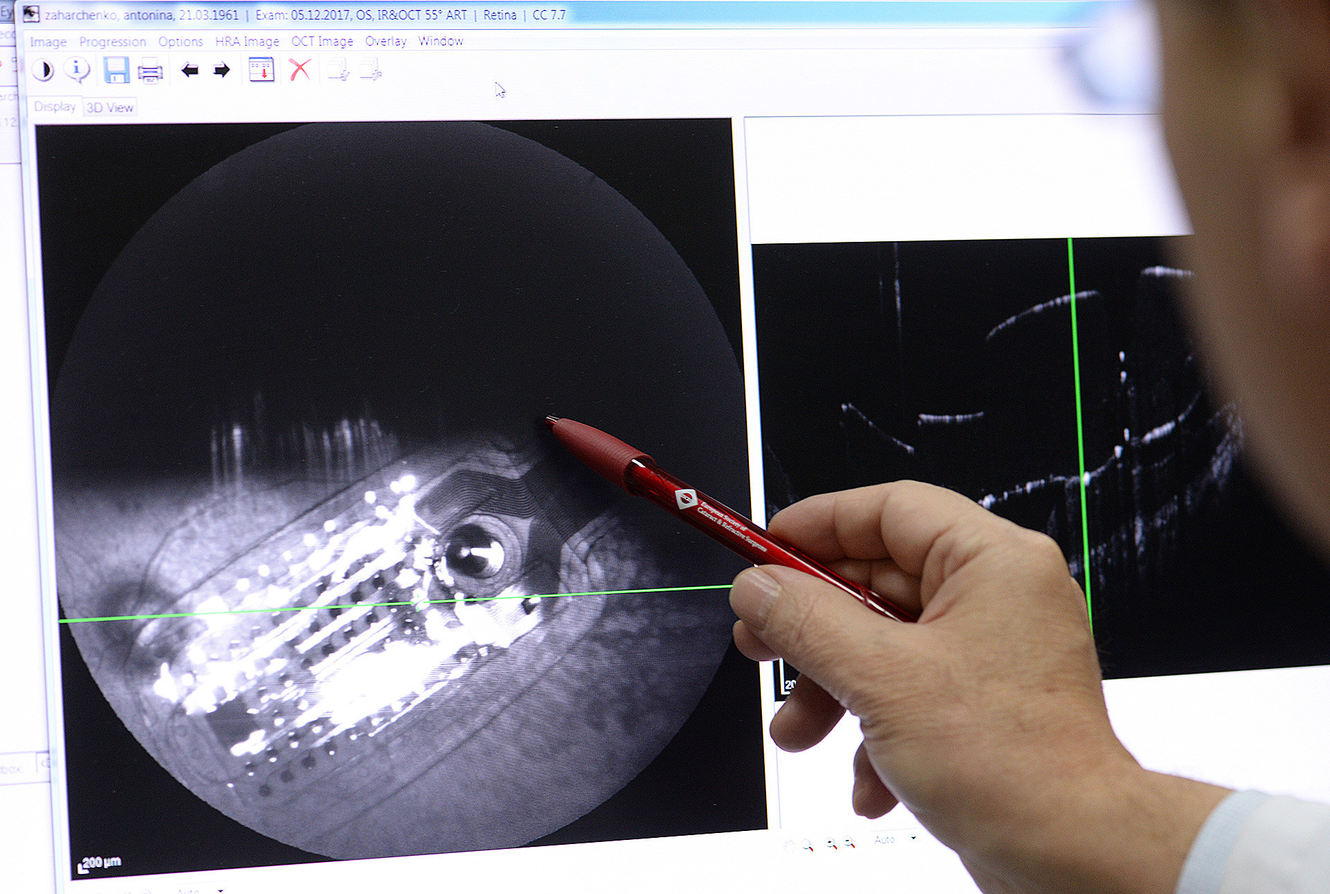 Tokom operacije se u žutu mrlju, centralni deo mrežnjače, ugrađuje mikročip i pacijent je u stanju da vidi sliku u pikselima.