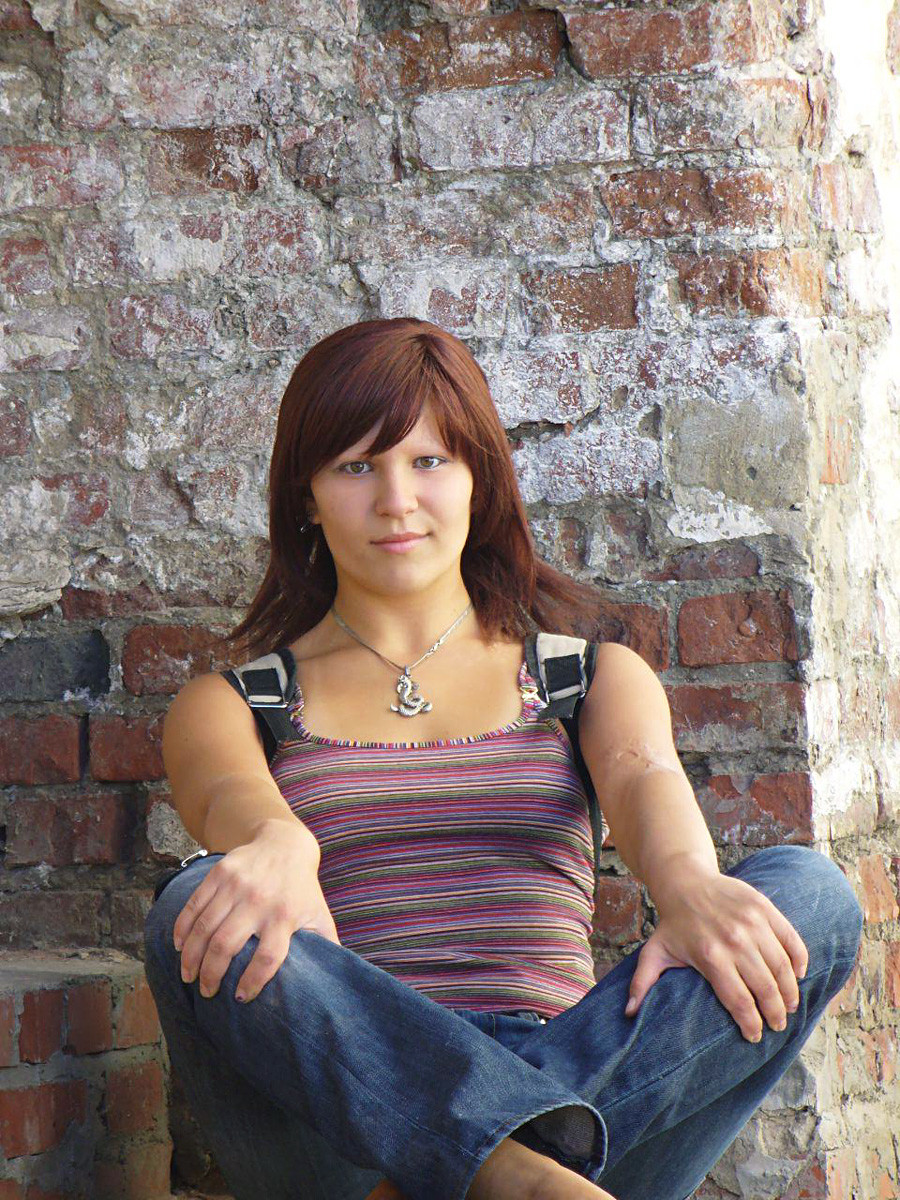 alopecia capelli Hair loss anemia anorexia due bulimia visihow remedies homeopathic treat use vs bites bug