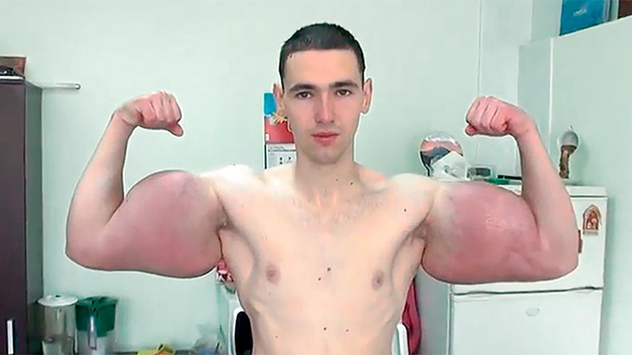 Synthol Buttock Injections